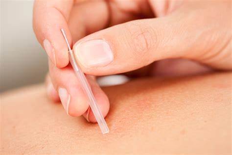 dry-needling-picture Acupuncture Immune System Cairns