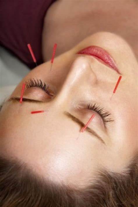 acupucnture-for-sinusitis Acupuncture for Allergies Cairns